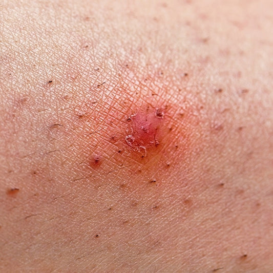 Ingrown Hair: Symptoms, Causes & Treatments